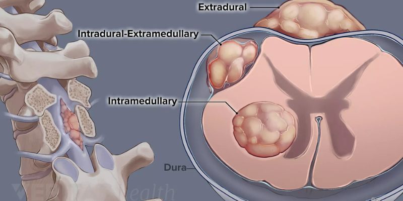 How Long Can You Live With Cancer in Your Spine