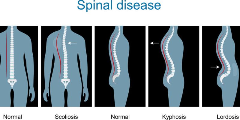 What Are the Different Types of Spine Care Treatments Available?