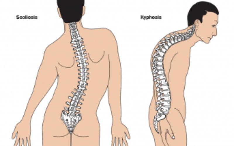 Adult Onset Scoliosis