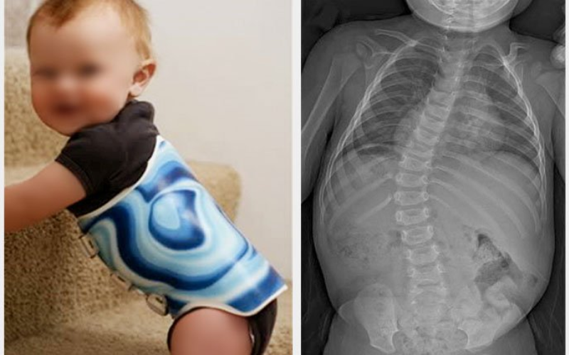 Infant Scoliosis and Physcial Therapy Treatments