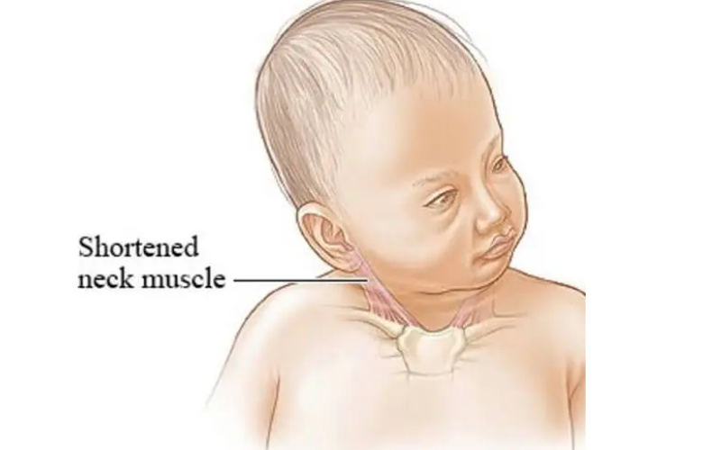  Torticollis and Plagiocephaly